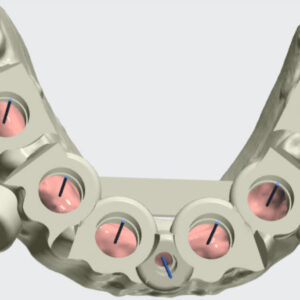 Guia Quirurgica Impresa en 3D